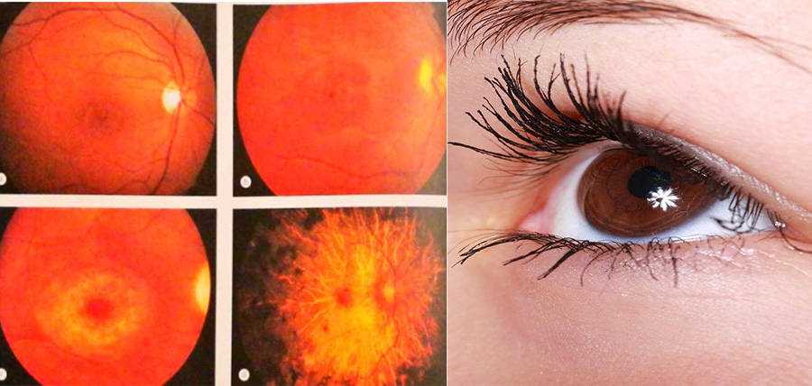 Μέχρι τύφλωση μπορεί να προκαλέσει η χρήση χλωροκίνης και υδροξυχλωροκίνης article cover image