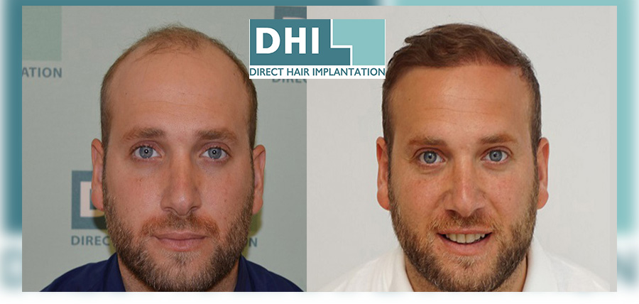 Δωρεάν Διάγνωση Τριχόπτωσης DHI Alopecia DNA test article cover image