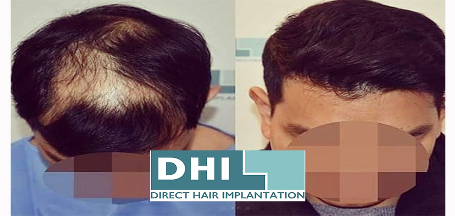 Μεταμόσχευση Μαλλιών DHI Direct ! article cover image