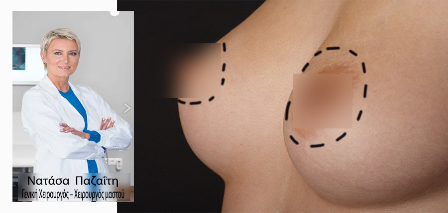 Υποδόρια μαστεκτομή διατήρησης θηλής (Nipple – sparing mastectomy) article cover image