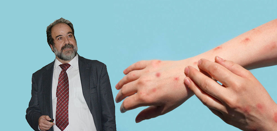 Το προφίλ του ιού της ευλογιάς των πιθήκων – Τι αναφέρει ο καθηγητής Χρήστος Χατζηχριστοδούλου article cover image