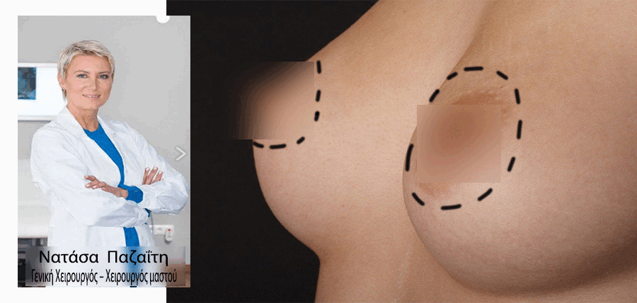 Καρκίνος του μαστού και αποκατάσταση article cover image